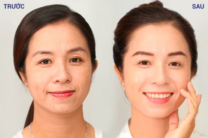 Da chị Tiên căng bóng, mịn màng, nếp nhăn vùng mắt, rãnh cười cải thiện sau khi gửi gắm nhan sắc tại Thẩm mỹ viện Ngọc Dung Phan Thiết.