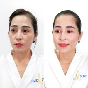  Kết quả trước và sau khi trị liệu bằng công nghệ Helios IV 785