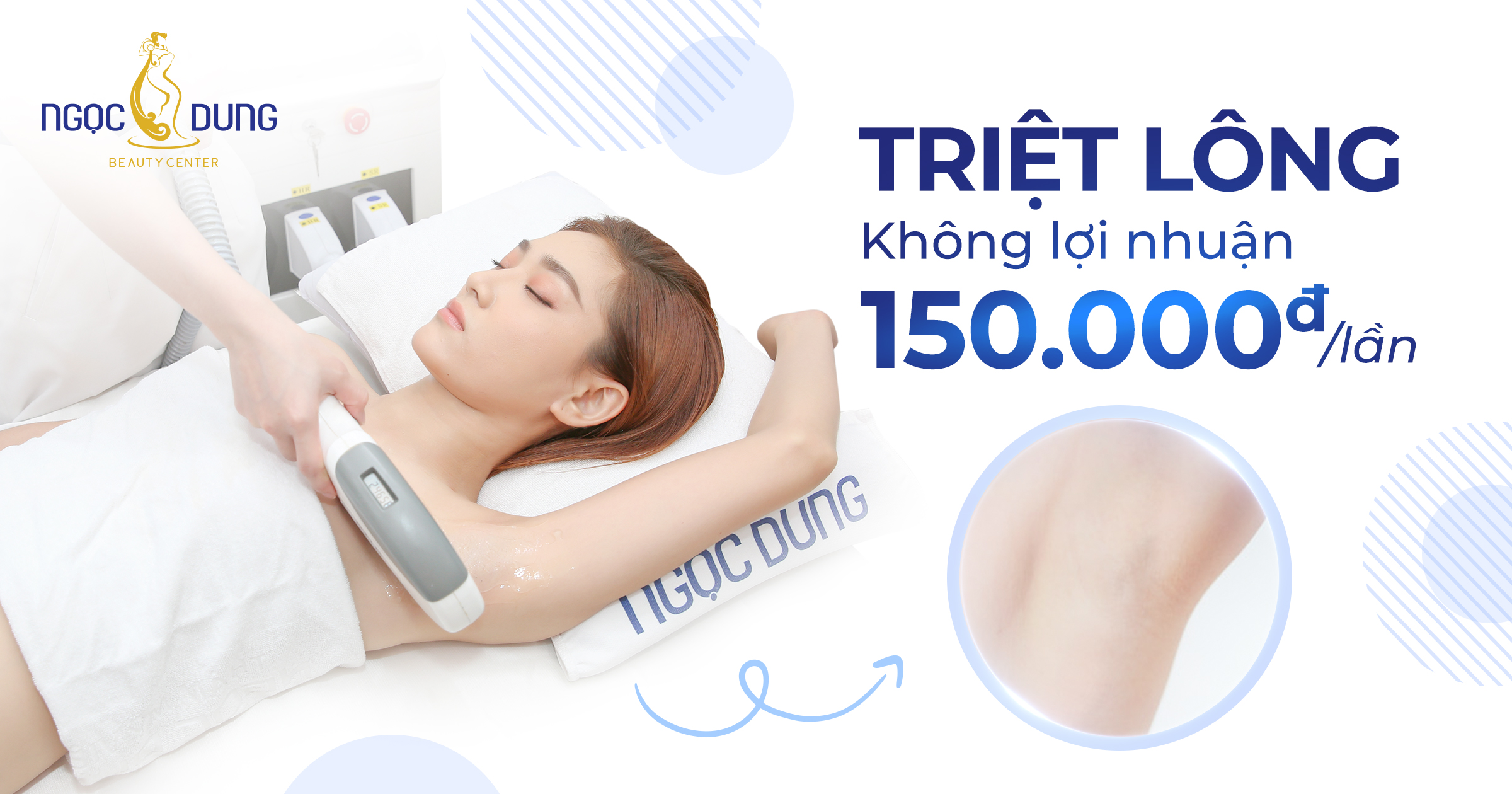 Triệt Sạch Lông – Da Sáng Mịn Chỉ 150k/lần