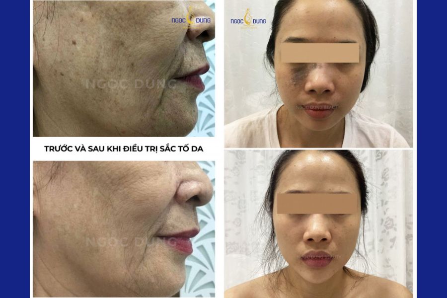 Khách hàng điều trị tăng sắc tố da