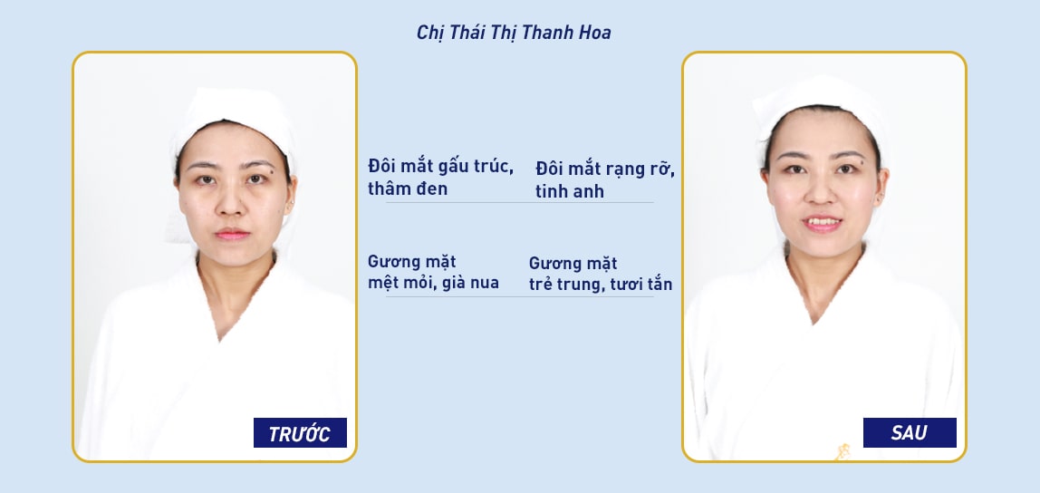 Kết quả điều trị thâm quầng mắt của chị Hoa