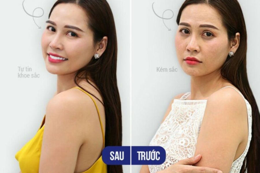 Khách hàng trước và sau khi điều trị thâm quầng mắt Khách hàng trước và sau khi điều trị thâm quầng mắt