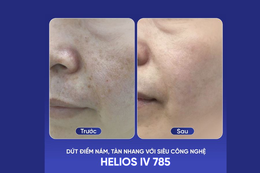 Khách hàng điều trị nám da