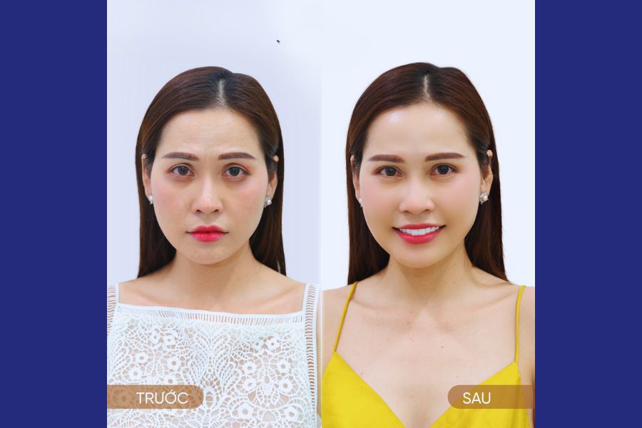 Khách hàng điều trị thâm vùng mắt