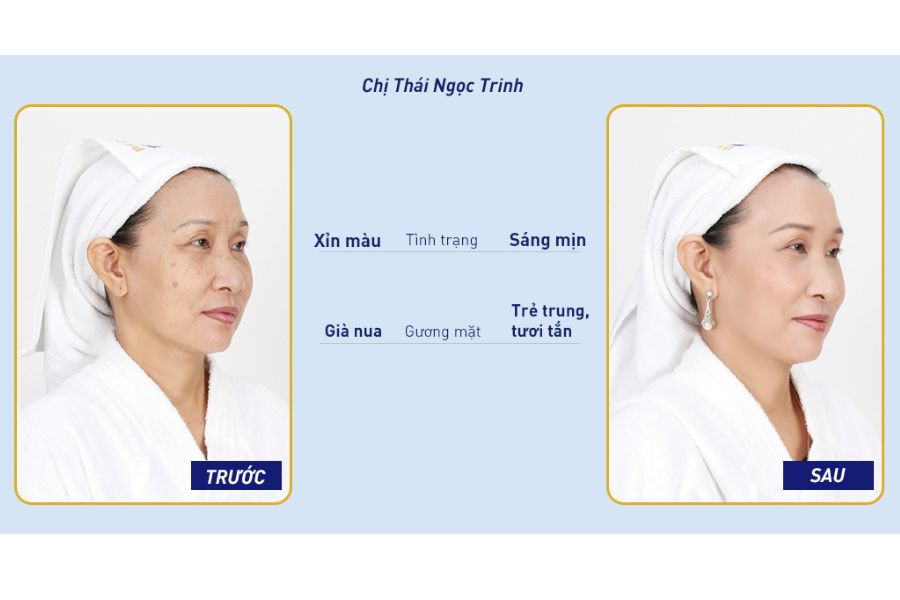 Khách hàng sở hữu làn da sáng mịn, trẻ trung sau khi kết thúc liệu trình làm đẹp tại TMV Ngọc Dung chi nhánh Vinh