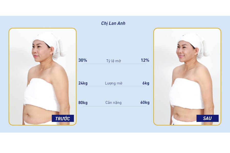 Khách hàng trước và sau khi sử dụng dịch vụ giảm béo tại Ngọc Dung