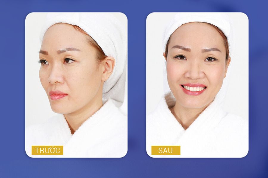 Nụ cười rạng rỡ tự tin cùng làn da trắng sáng sau khi trị nám thành công