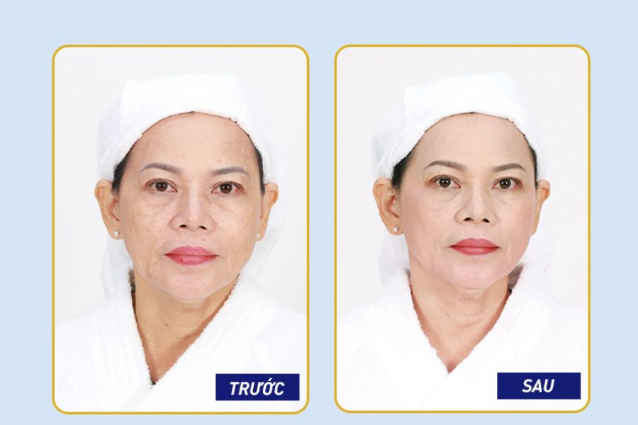 Thâm nám mờ đi, da sáng mịn giúp chị Thu Hà trở nên tự tin hơn