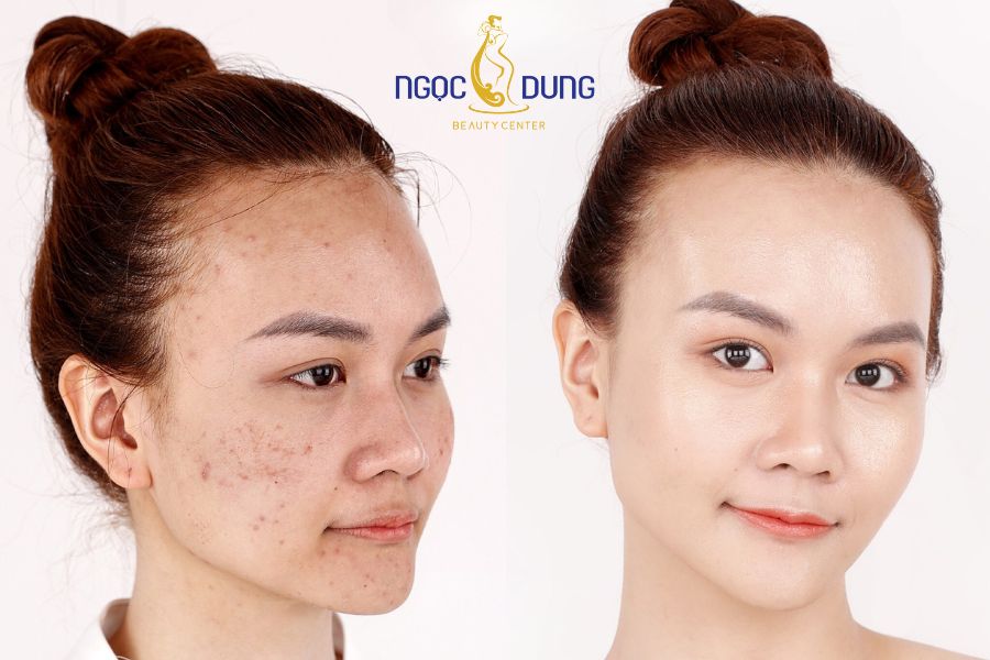 Sau khi điều trị thâm mụn bằng công nghệ Laser PicoLO làn da sáng khỏe không tỳ vết