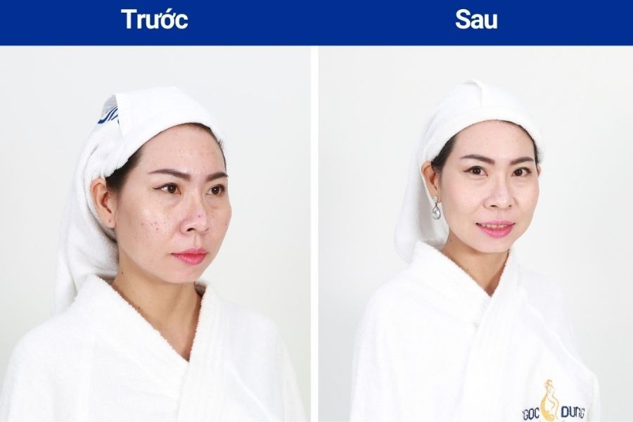 Những vết thâm mụn đã mờ đi chỉ sau 4 buổi thực hiện