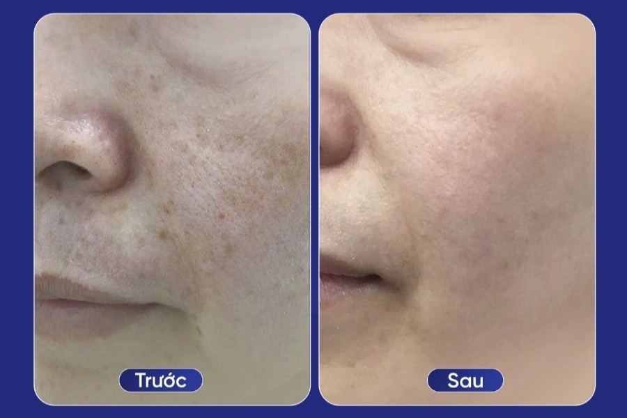 Chỉ sau một liệu trình điều trị, các vết nám được cải thiện rõ rệt