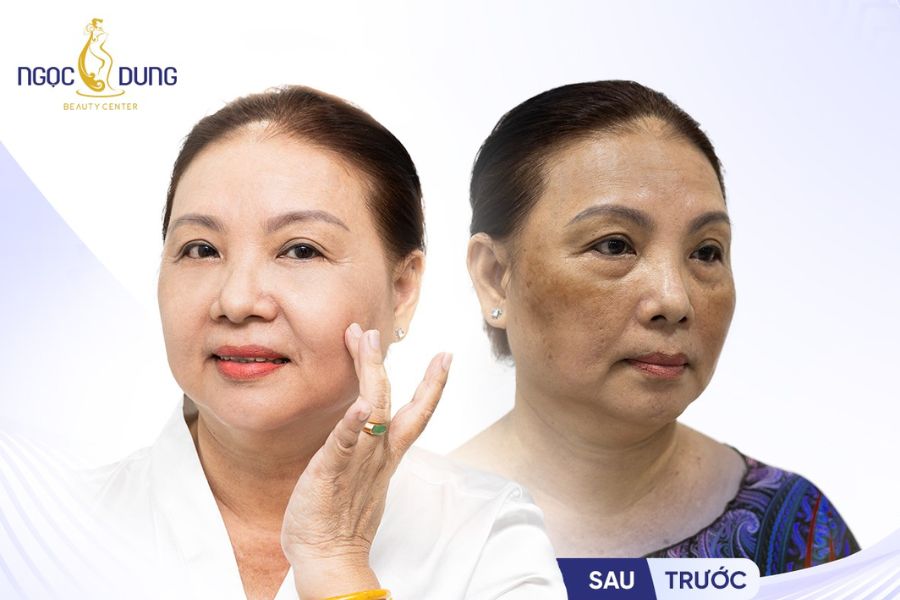 Hiệu quả điều trị nhanh chóng, phù hợp với mọi loại da