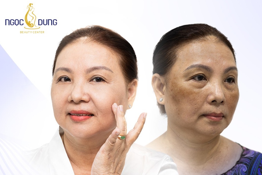 Da sáng mịn đều màu, các khuyết điểm trên da được cải thiện đáng kể khi sử dụng Picosure Pro tại Ngọc Dung