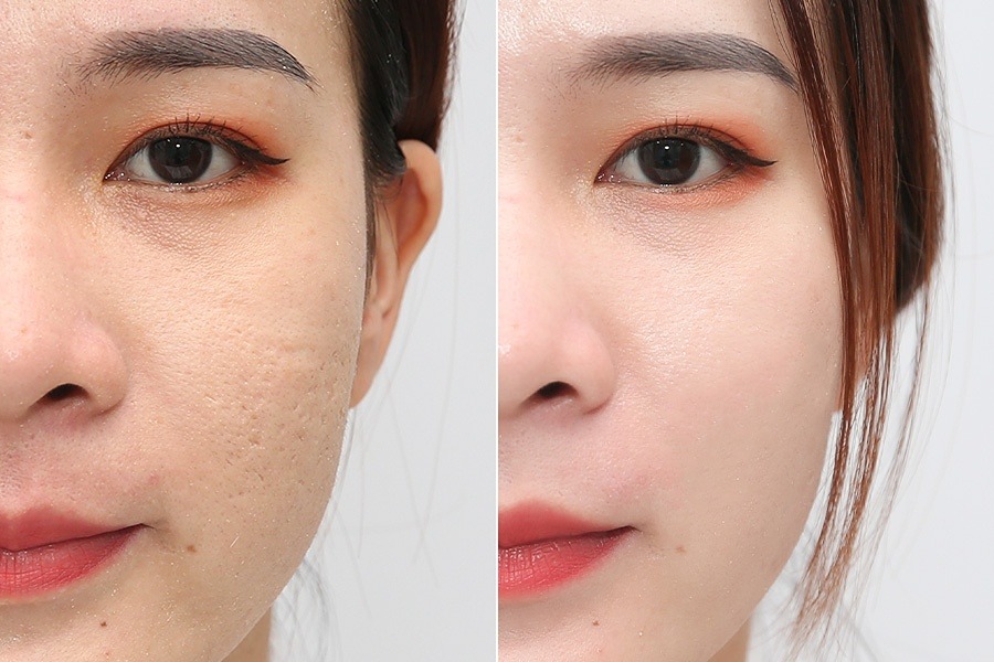 Trị sẹo rỗ – 8 liệu trình – Cải thiện sẹo lâu năm