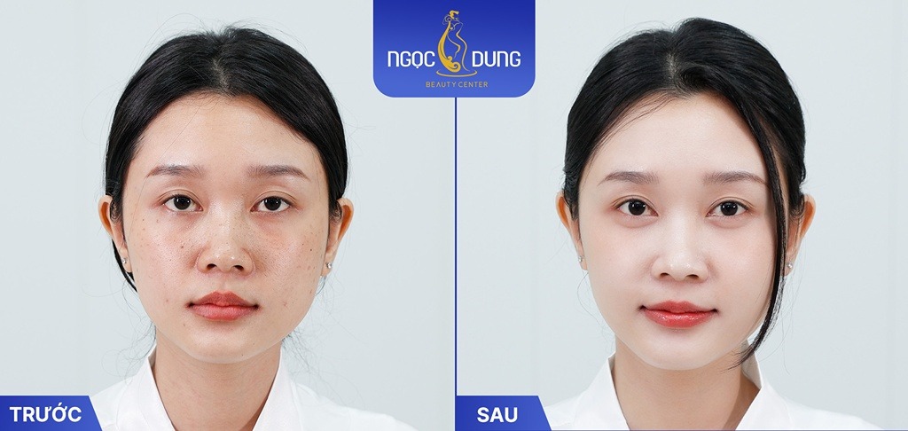 công nghệ mô sợi trị nám white perfect