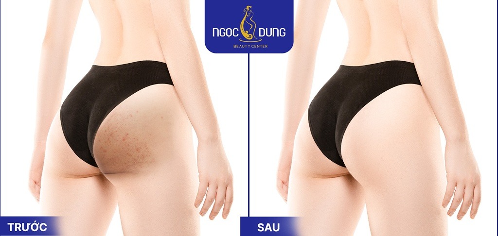 trị thâm mông bằng công nghệ