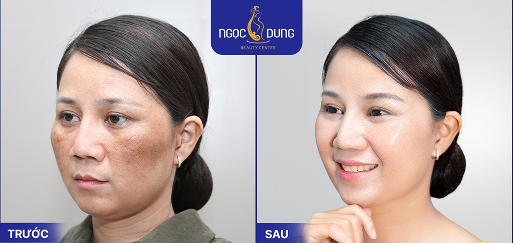 trẻ hóa da bằng công nghệ pico premium