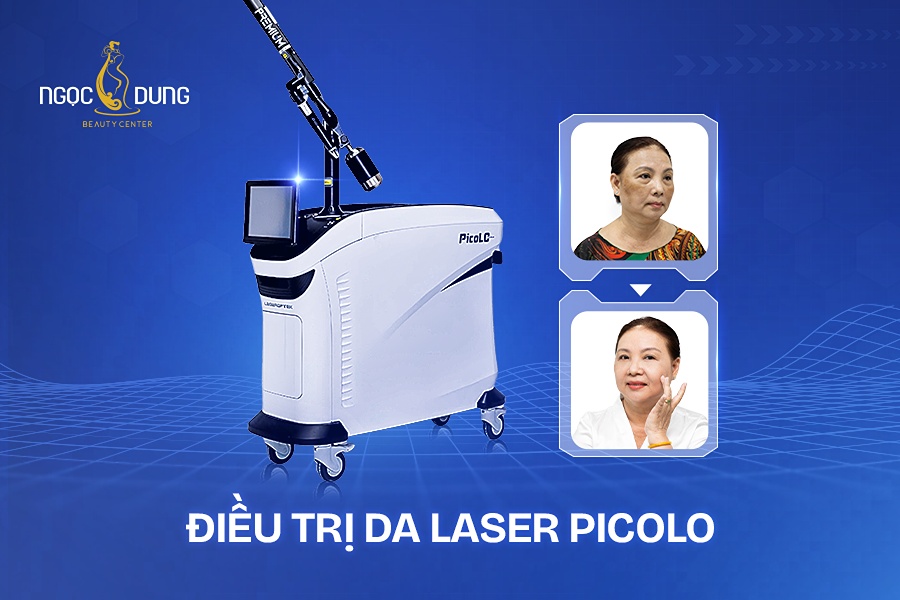 Siêu công nghệ Laser PicoLO Premium – Xóa sạch mọi khuyết điểm về da