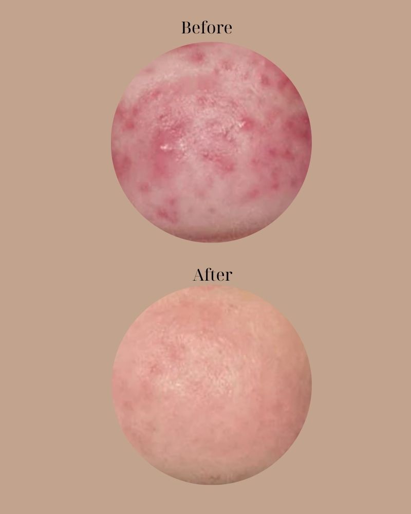 Giảm sưng đỏ sau khi trị mụn xong