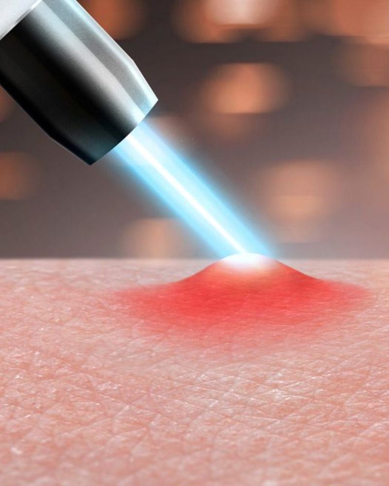 Hiệu quả trị mụn lưng gấp 3 lần phương pháp thường