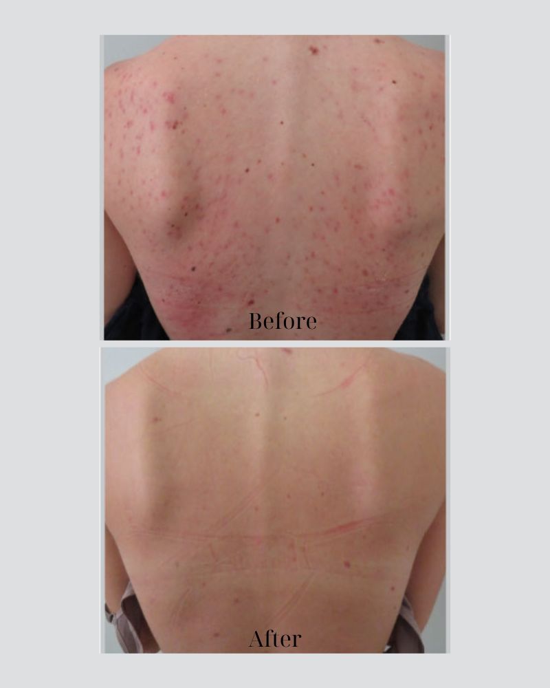 Cải thiện tình trạng mụn lưng sau lần điều trị đầu tiên