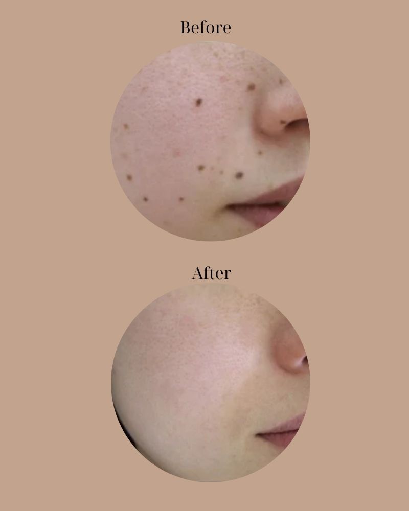 Xóa sạch nốt ruồi ngay lần đầu tiên