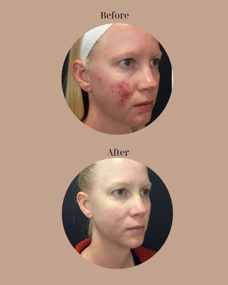 Cải thiện tình trạng mụn viêm