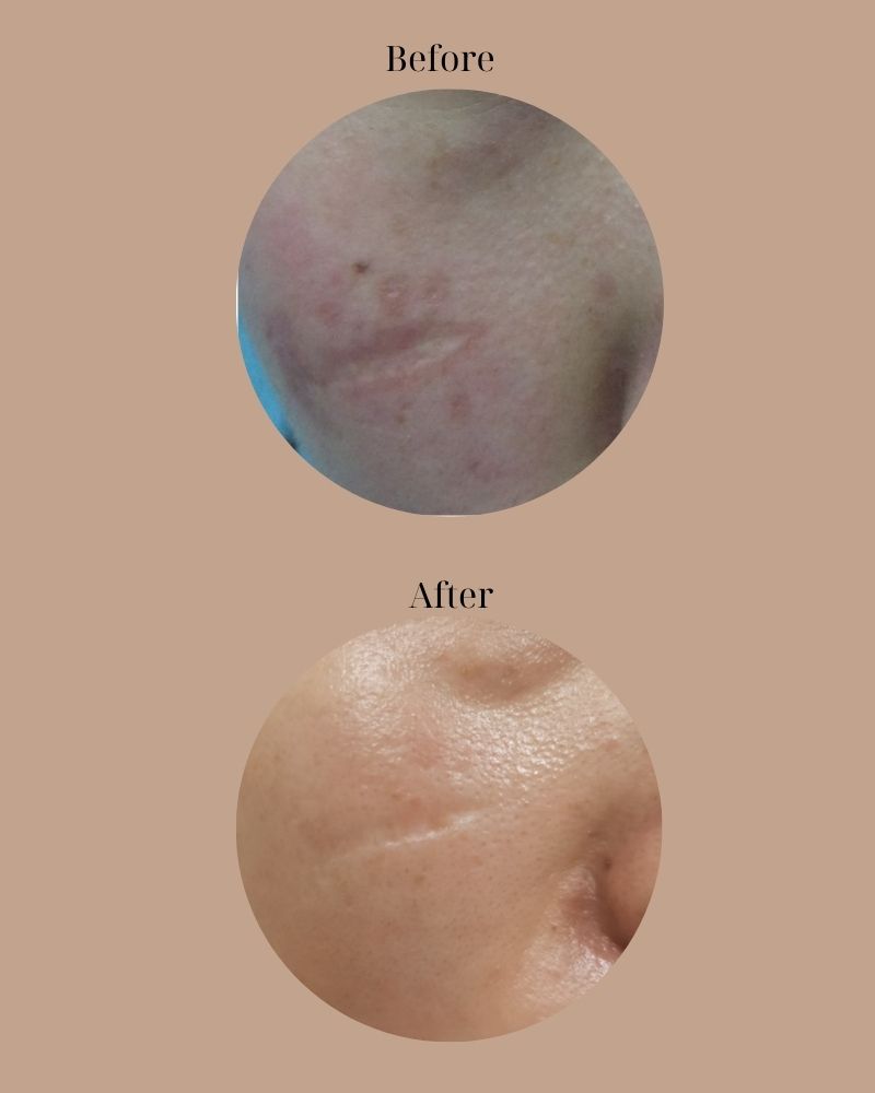 Phục hồi 80% tình trạng sẹo lõm