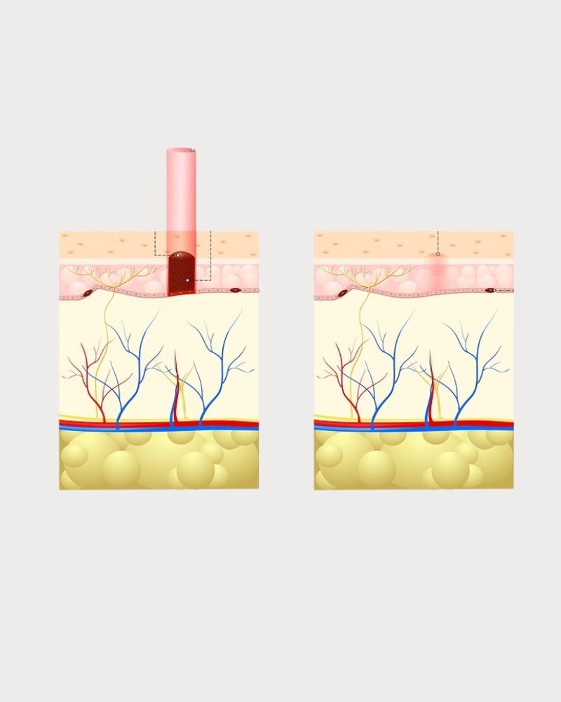 Tẩy nốt ruồi có chân sâu