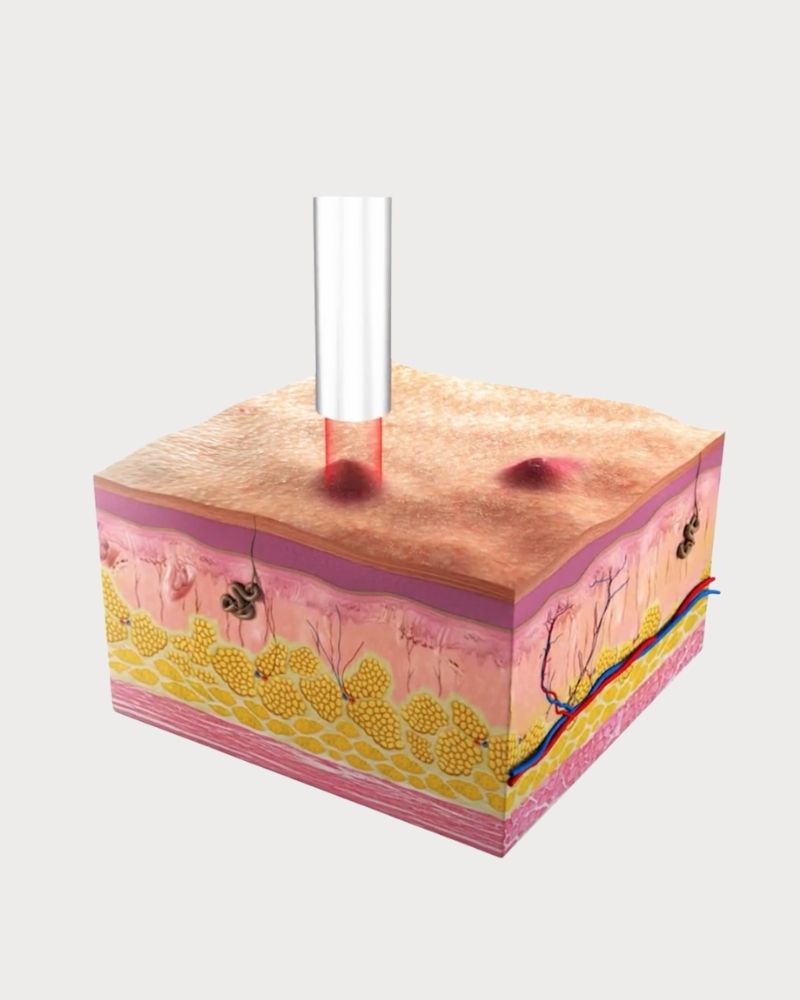 Tiêu diệt vi khuẩn gây mụn