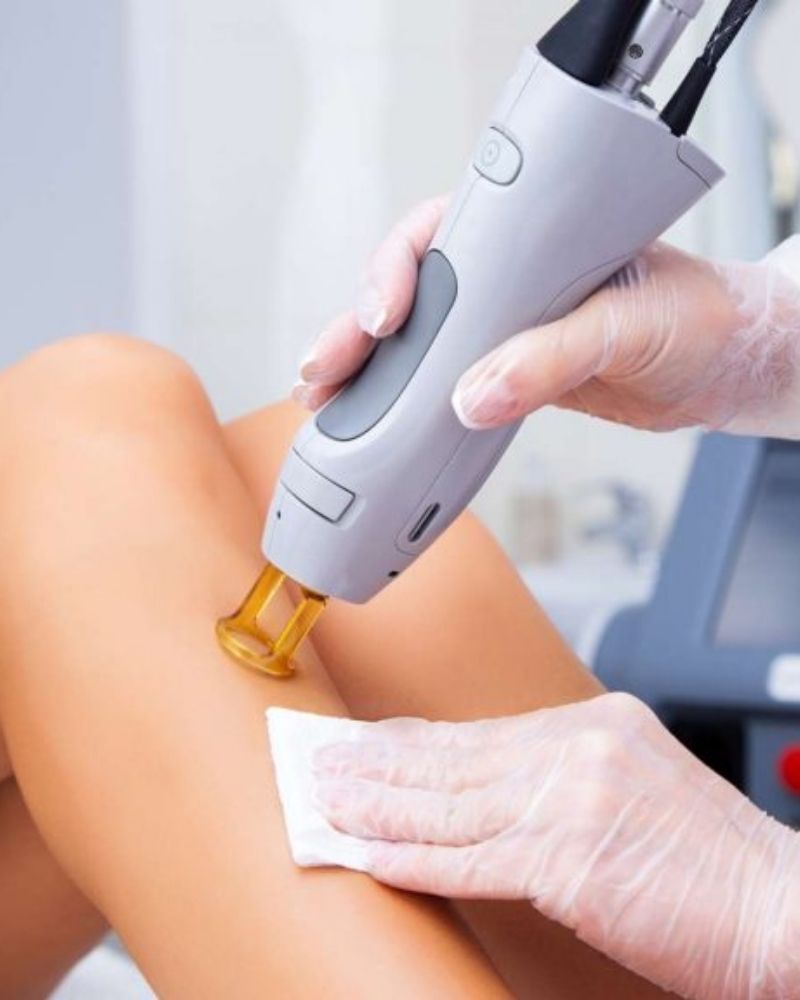 Trị viêm nang lông nhanh chóng với Laser