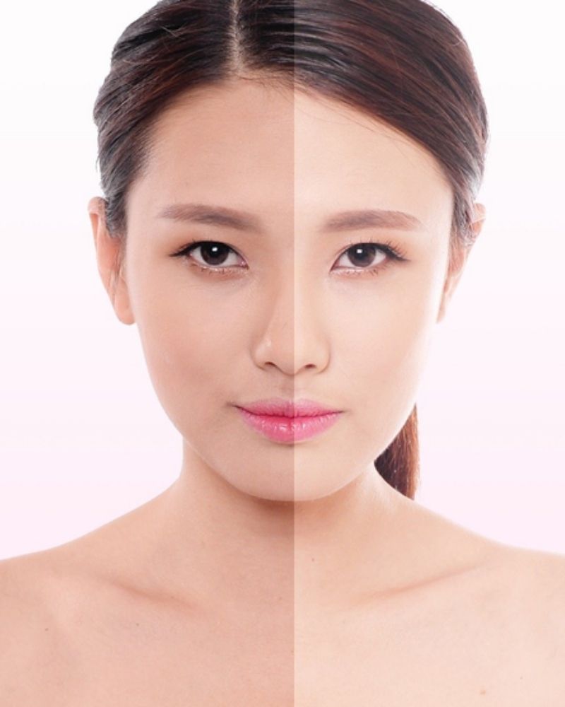 Cảo thiện tone da khi trị sẹo lõm