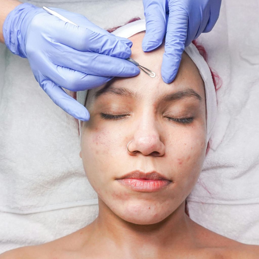 Trị mụn trứng cá dứt điểm tại Ngọc Dung