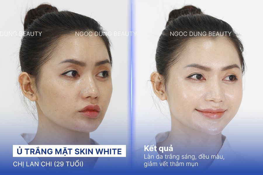 Ủ trắng mặt skin white – 6 buổi – Da đều màu tự nhiên