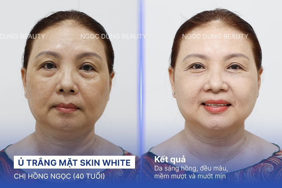 Ủ trắng mặt skin white – 5 buổi – Da khỏe đẹp ẩm mịn