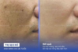 Anh Minh An (36 Tuổi) - Trị Sẹo Rỗ