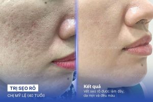 Chị Mỹ Lệ (40 tuổi) - Trị Sẹo Rỗ