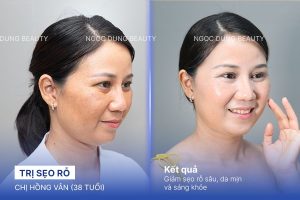 Chị Hồng Vân (38 tuổi) - Trị Sẹo Rỗ