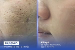 Anh Minh Khánh (34 tuổi) - Trị Sẹo Rỗ