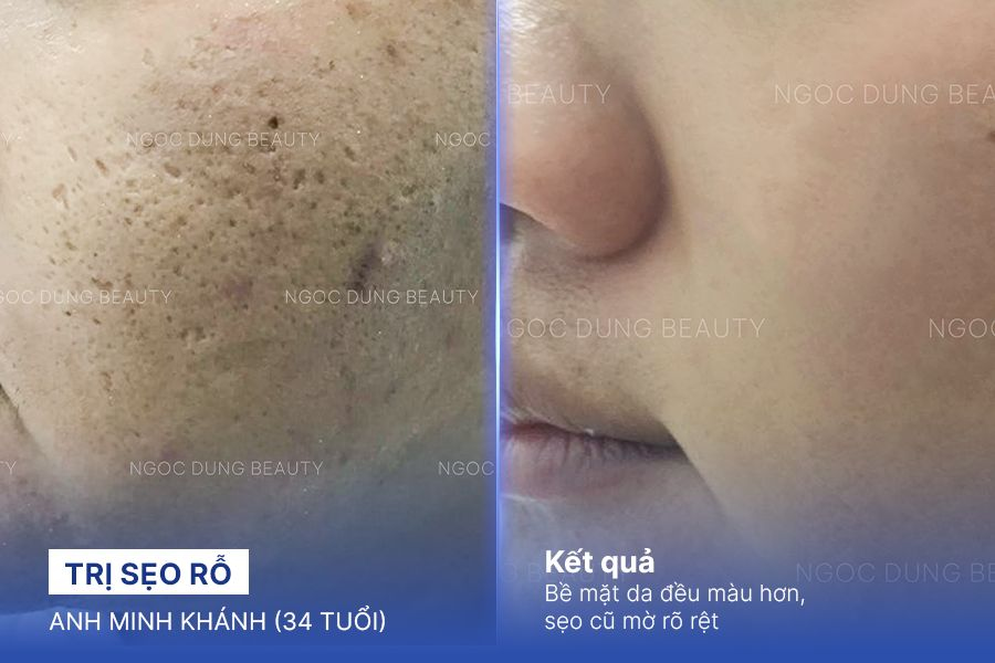 Trị sẹo rỗ – 4 Liệu trình – Mờ sẹo và da đều màu