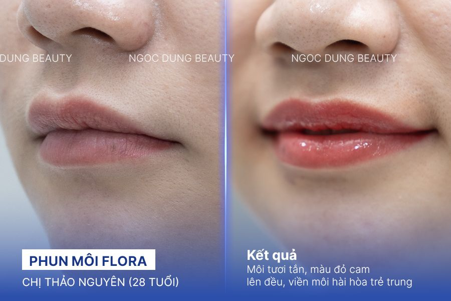 Chị Thảo Nguyên (28 tuổi) - Phun Môi Flora