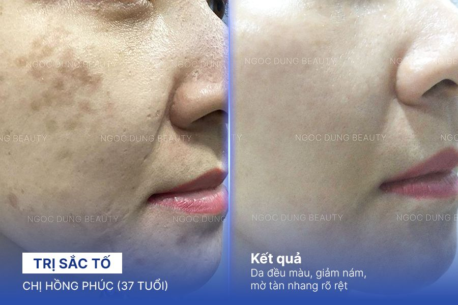 Chị Hồng Phúc (37 tuổi) - Trị Sắc Tố