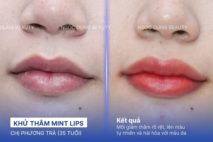Khử thâm Mint Lips – 120 phút – Nền môi sáng mịn