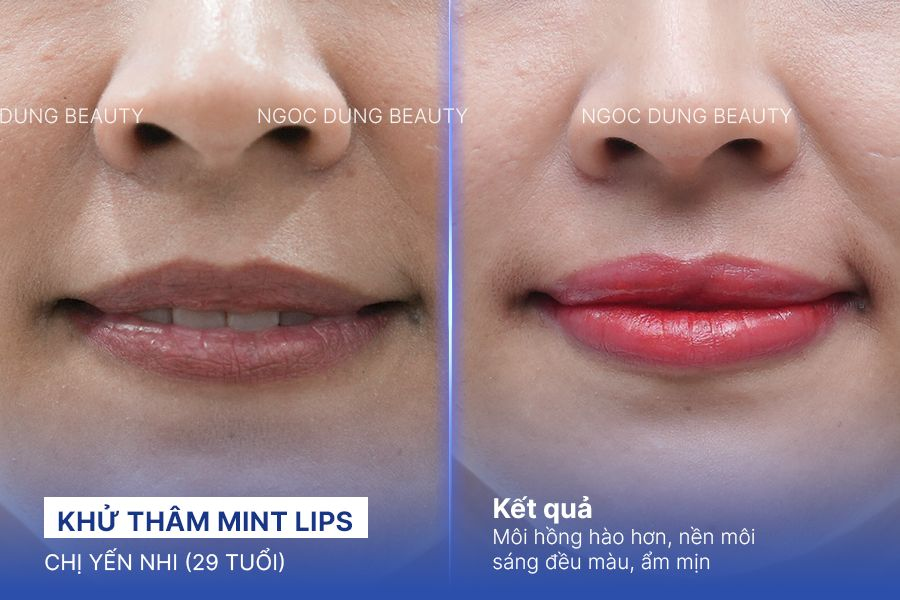 Khử thâm Mint Lips – 120 phút – Môi mềm căng mọng