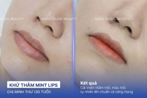 Chị Minh Thư (30 tuổi) - Khử Thâm Mint Lips