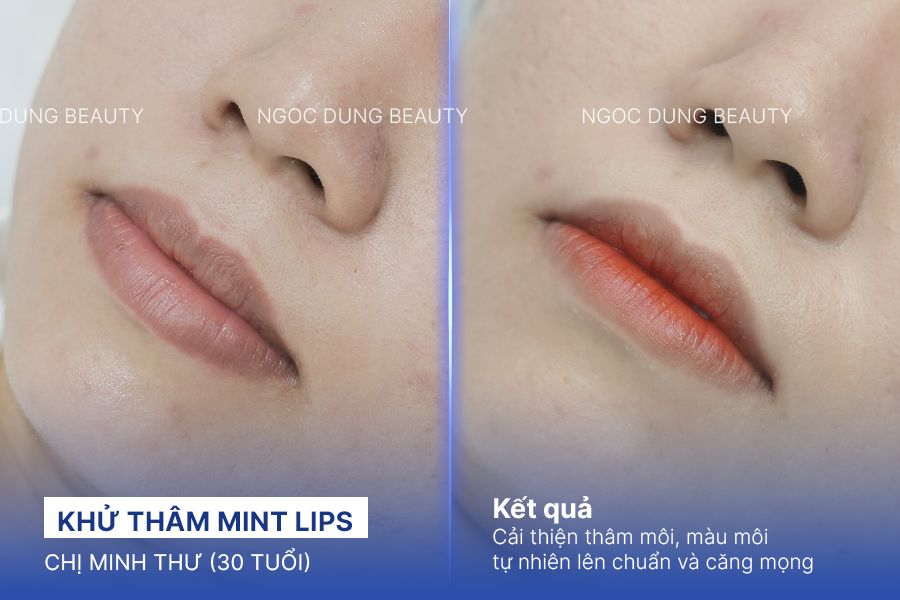 Khử thâm Mint Lips – 100 phút – Nền môi đều màu