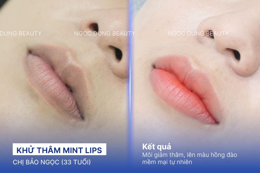 Khử thâm Mint Lips – 100 phút – Môi mịn tự nhiên