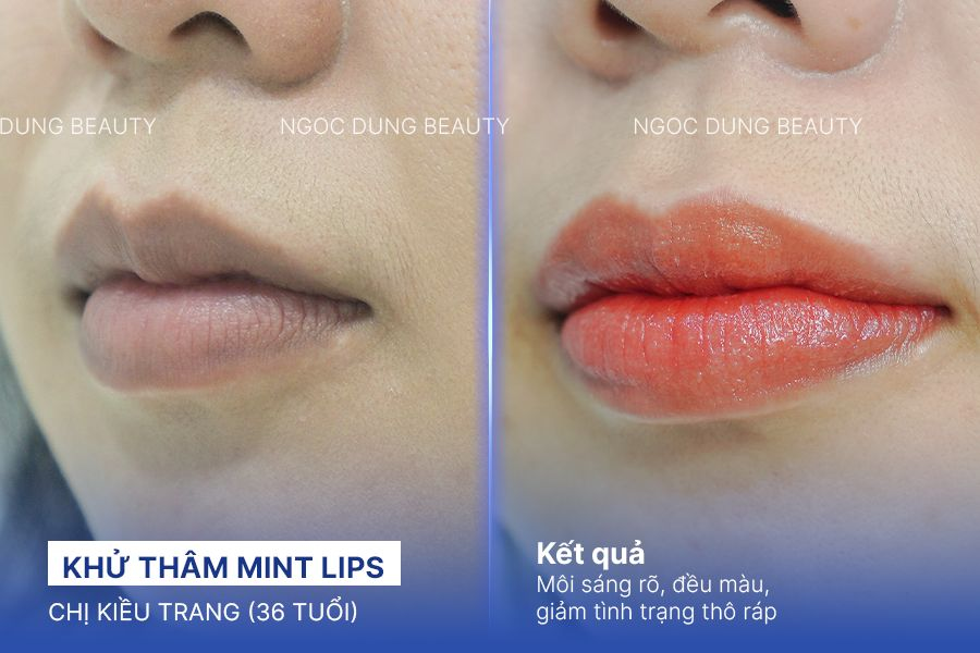 Khử thâm Mint Lips – 90 phút – Nền môi mịn màng