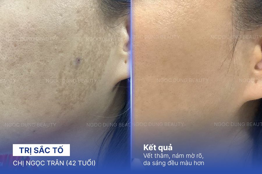 Chị Ngọc Trân (42 tuổi) - Trị Sắc Tố