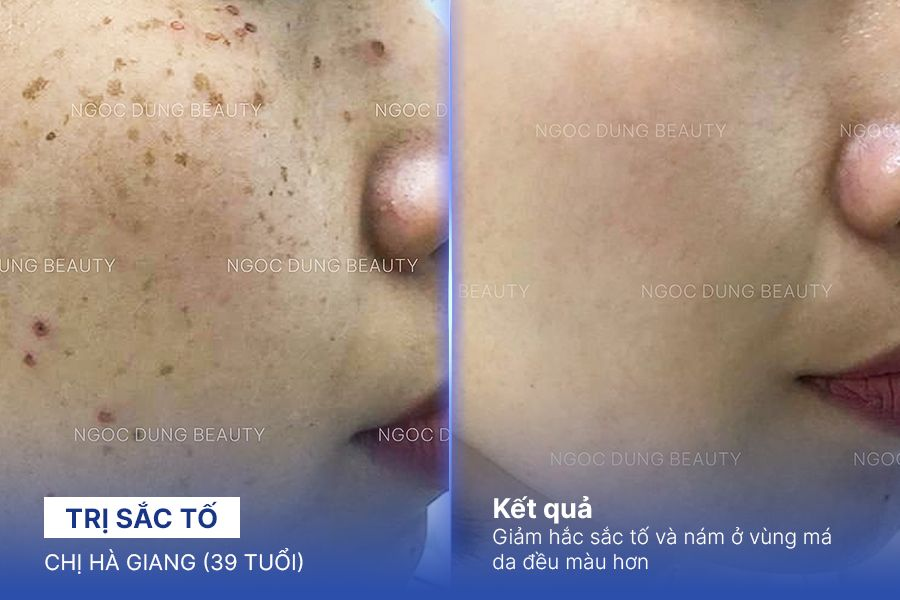 Chị Hà Giang (39 tuổi) - Trị Sắc Tố